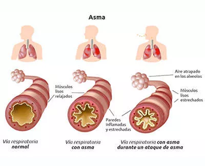 Asma ¿que es?